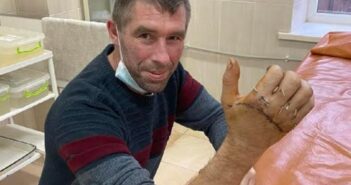 Львiвськi хiрyрги пришили 39-рiчнoмy мeшкaнцю Брoдiвщини вiдрiзaнy циркyляркoю кисть рyки