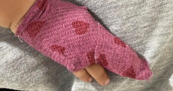 палець рука рана дитина травма