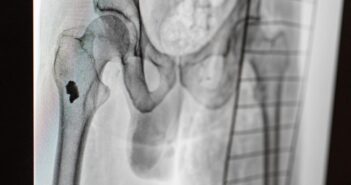 рентген стегно осколкове поранення